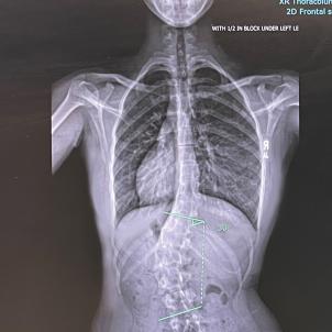 X-Ray image shows curvature of the patient's spine