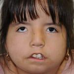 child without ability to smile before surgery 