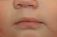 cleft lip after photo
