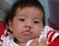 Cleft Lip and Palate Before Photo