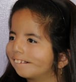 child without the ability to smile, after surgery, displaying maximal smile