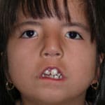 child without ability to smile before surgery, displaying maximal smile