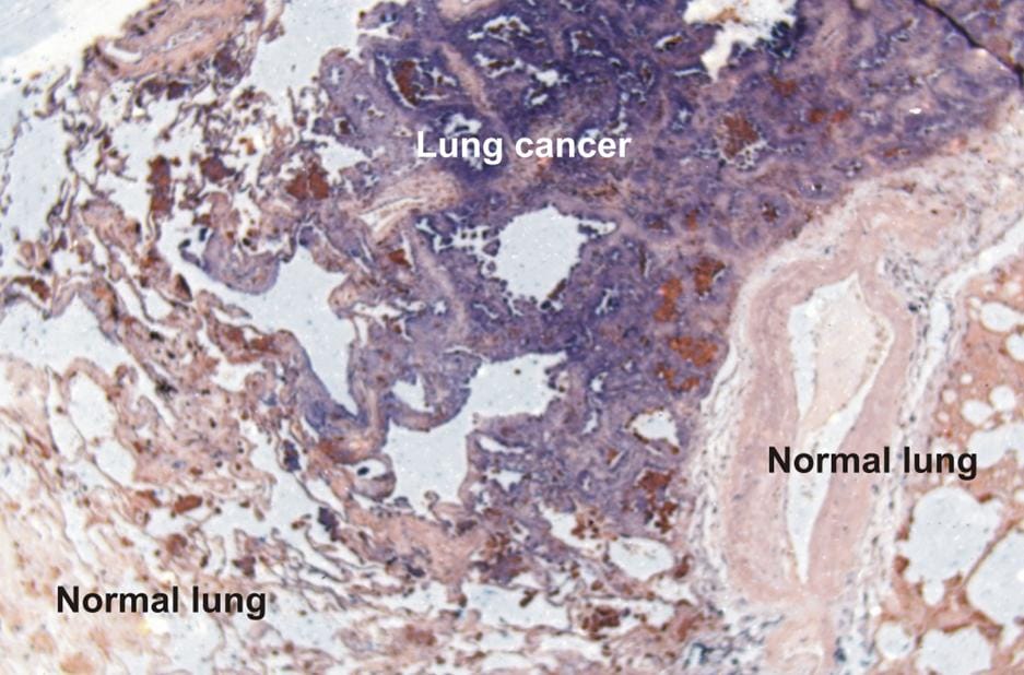 Lung Cancer Research