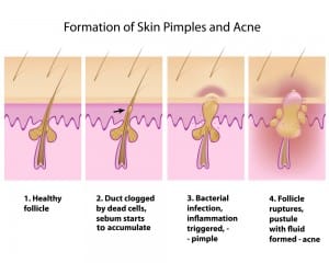formation of pimples acne