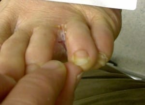ringworm on feet