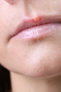 Uncovering Cold Sore Facts and Prevention Methods 