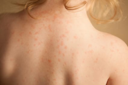 Young girl with skin rash caused by allergy.
