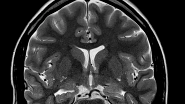Black and white image of a brain with temporal lobe asymmetry captured through magnetic resonance imaging (MRI).