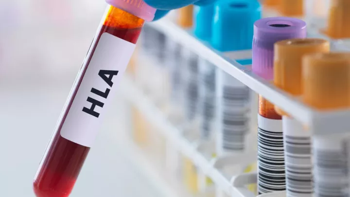 Test tube sample labeled as HLA Human leukocyte antigen