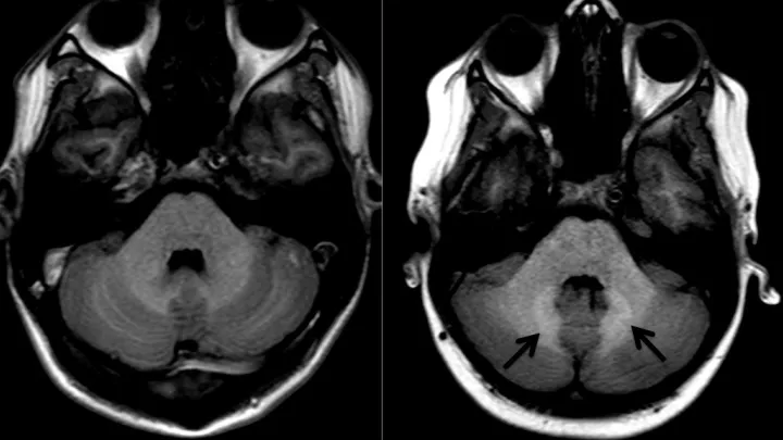 MRI of brain (1).jpg