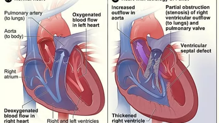 chla-nhlbi-nih-tetralogy-of-fallot.jpeg