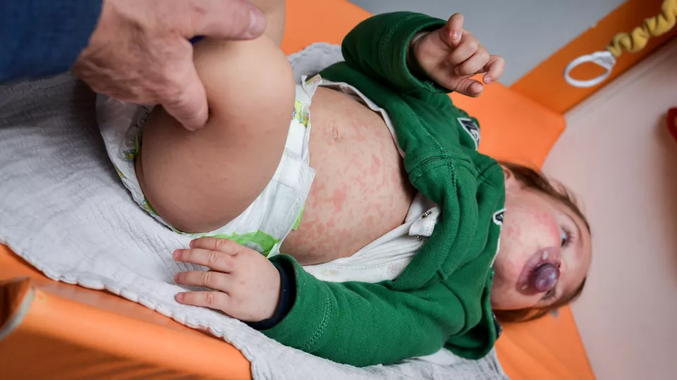 An infant lays on a changing table with a measles rash covering their abdomen. 