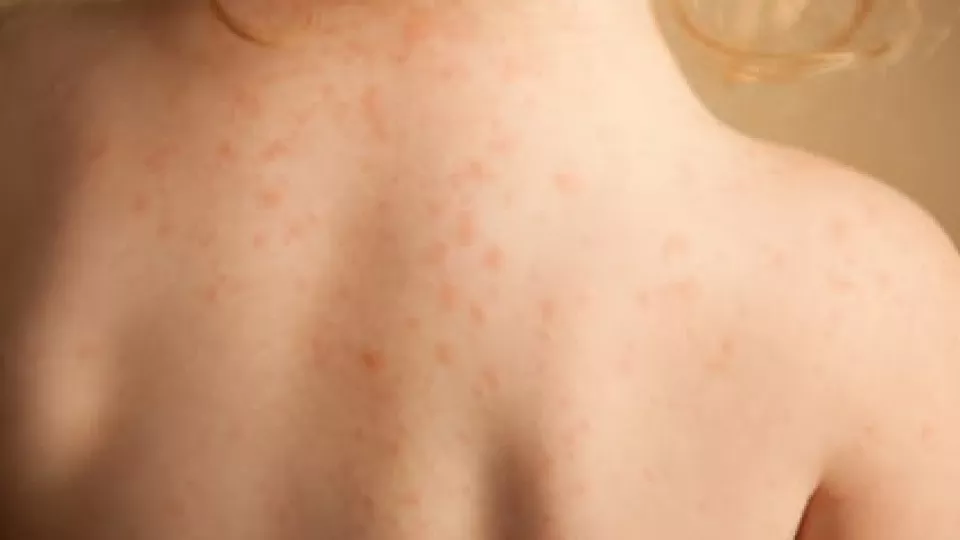 Young girl with skin rash caused by allergy.