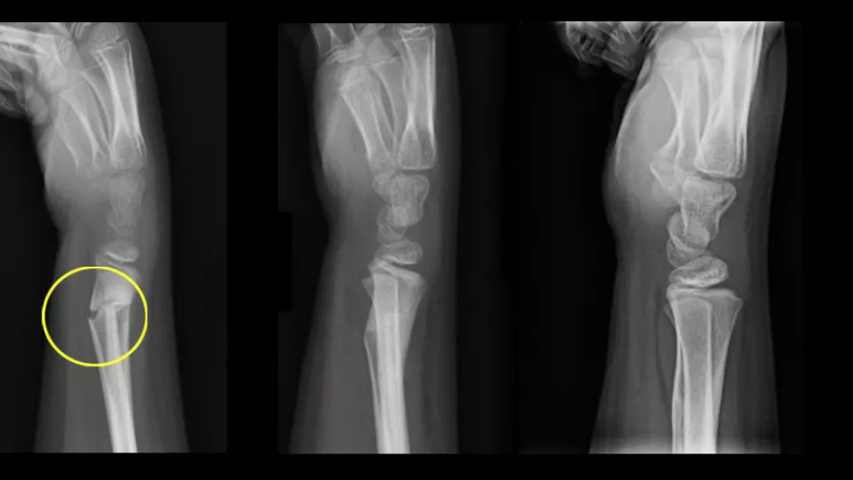 X-ray images of arm showing progression of fracture treatment