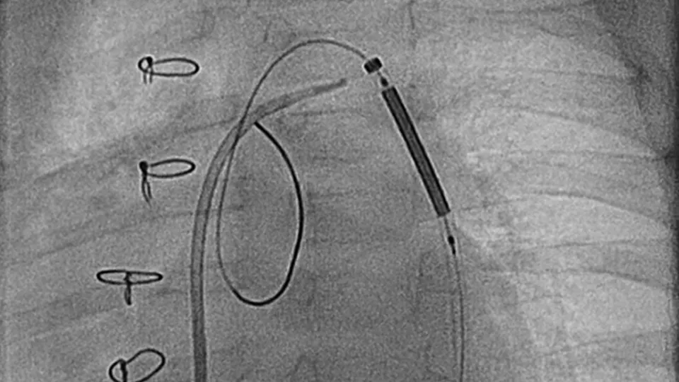 X-ray of human stent