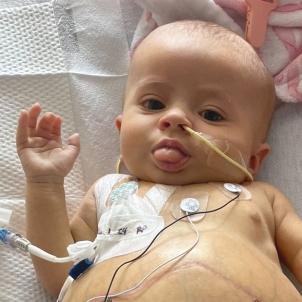 A light skin tone baby with a swelling abdominal lying on a hospital bed