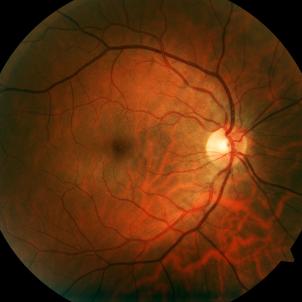 A microscope image of a human retina.