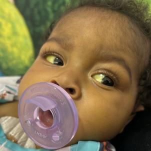 Dark-skinned baby with pacifier and yellowish eyes