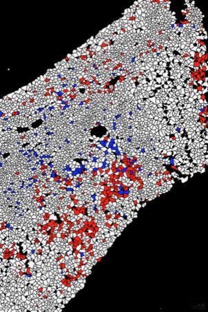 T-cells in a pediatric acute liver failure biopsy