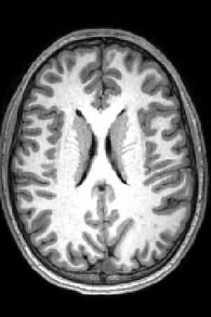 Axial MRI Peterson.jpg