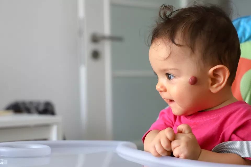 A baby with light skin tone and dark hair sits in a high chair. They have a rubbery, red bump on their cheek.