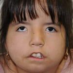 child without ability to smile before surgery