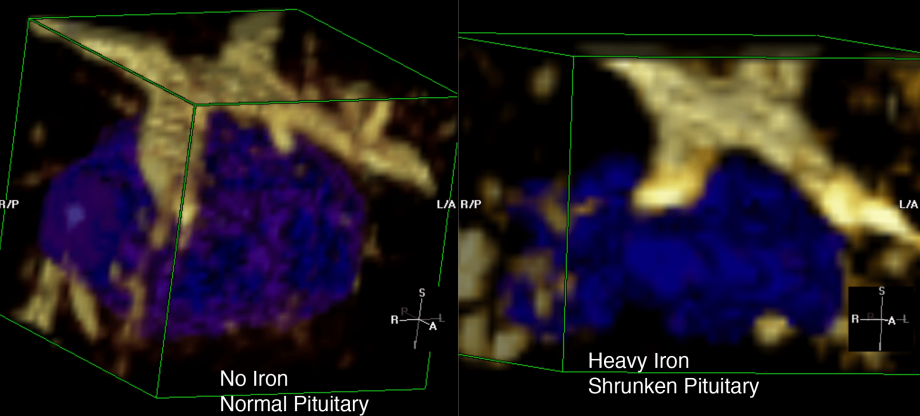 Iron Pituitary