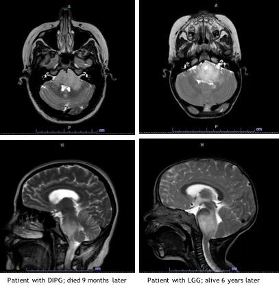 Brain stem tumors.jpg