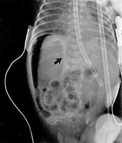 Picture B - X-Ray image of infant torso