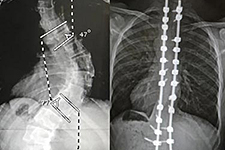 Xrays reveal spinal procedure