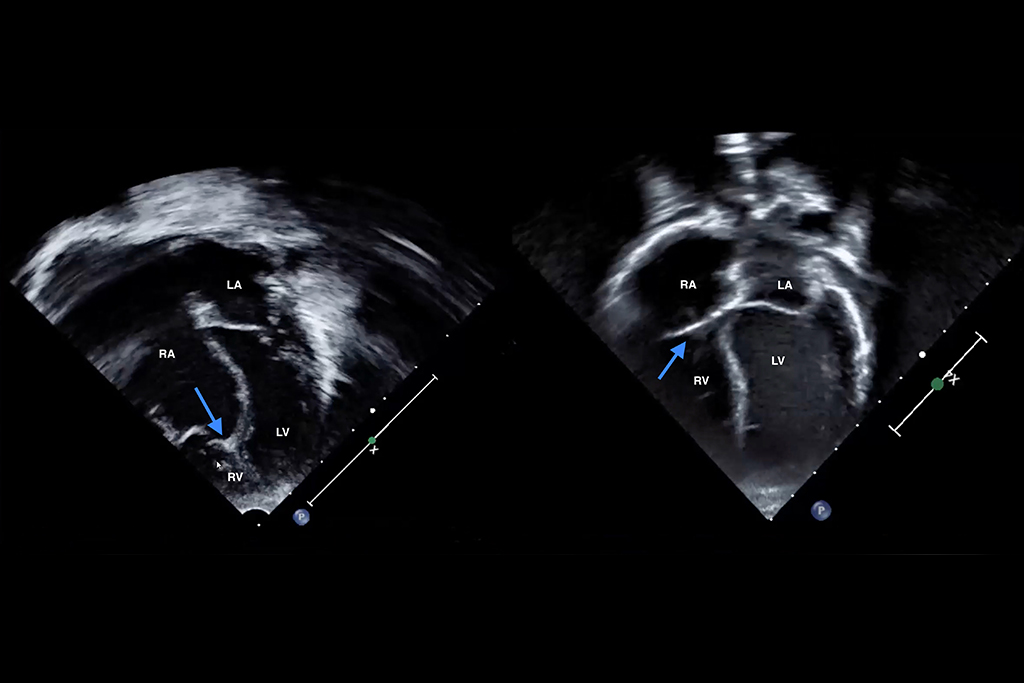 Two side-by-side echocardiogram images with ventricles highlighted