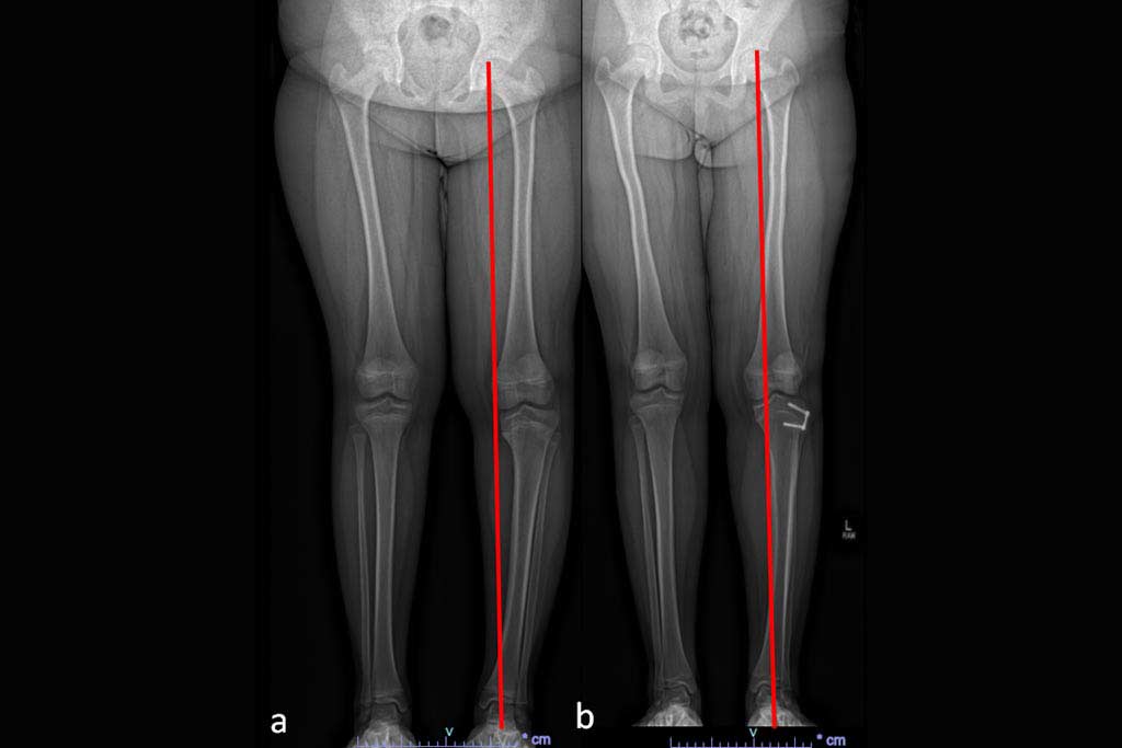 CHLA-Blog-Genu-Varum-Bowlegs-in-Children-1024x683.jpg CHLA-Blog-Genu-Varum-Bowlegs-in-Children-1024x683.jpg