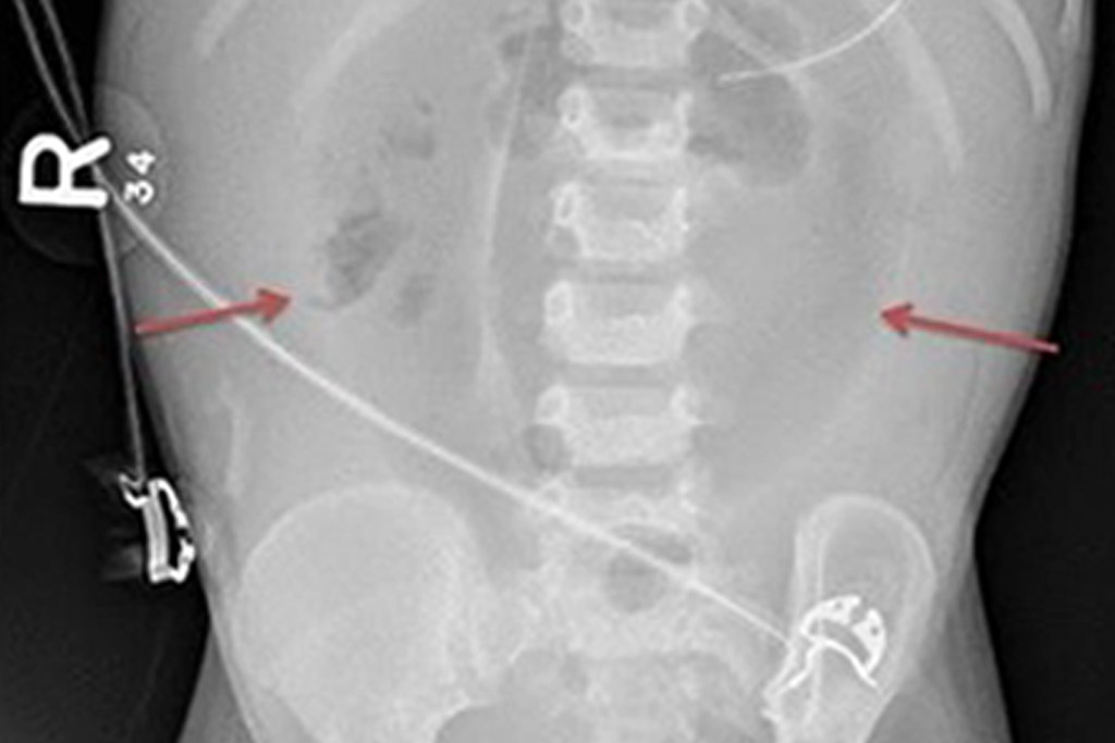 CHLA-Blog-Necrotizing-Enterocolitis-1024x683-01.jpg CHLA-Blog-Necrotizing-Enterocolitis-1024x683-01.jpg