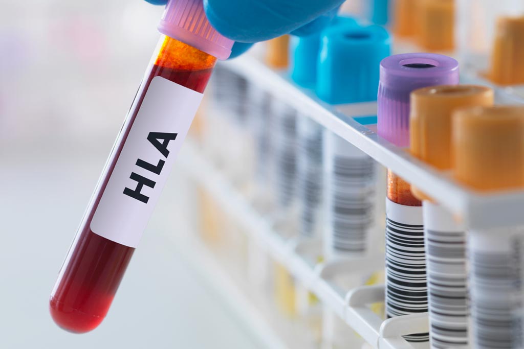 Test tube sample labeled as HLA Human leukocyte antigen
