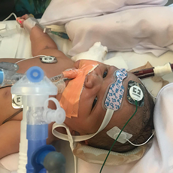 Infant Martin connected to ECMO machine at CHLA