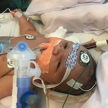 CHLA-Martin-ECMO-355x355.jpg Infant Martin connected to ECMO machine at CHLA