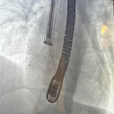 X-ray image of retrieval device inside heart