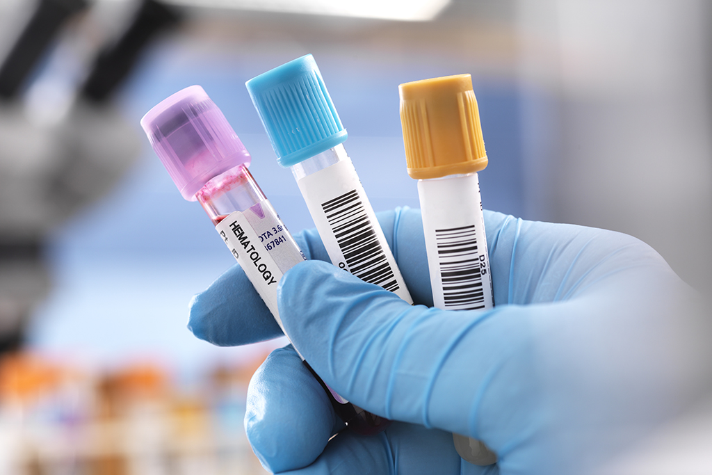 Hand wearing surgical latex glove holding three vials containing patient samples