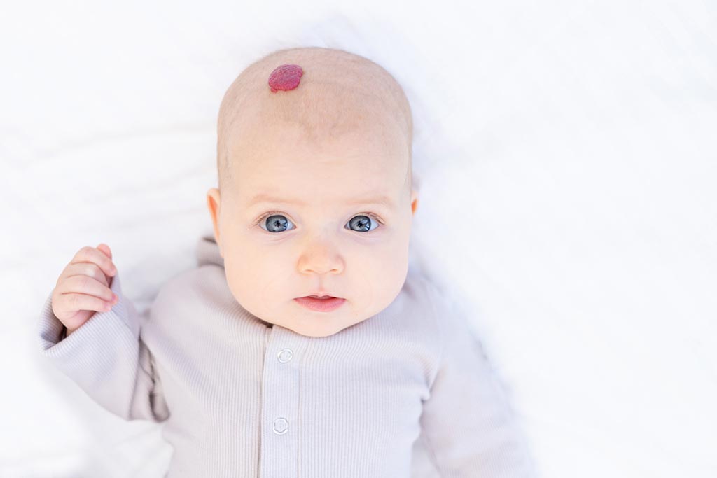 Hemangioma-GettyImages-1356598901.jpg