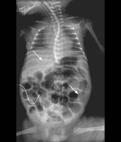 Picture A - X-Ray image of infant torso