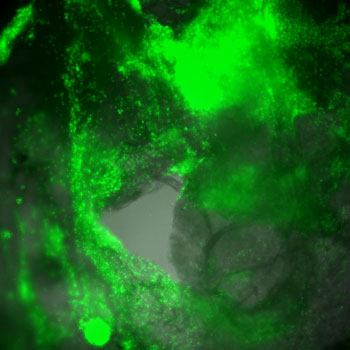 Confocal microscopy of DIPG cells growing in 3D on a decellularized brain tissue scaffold 